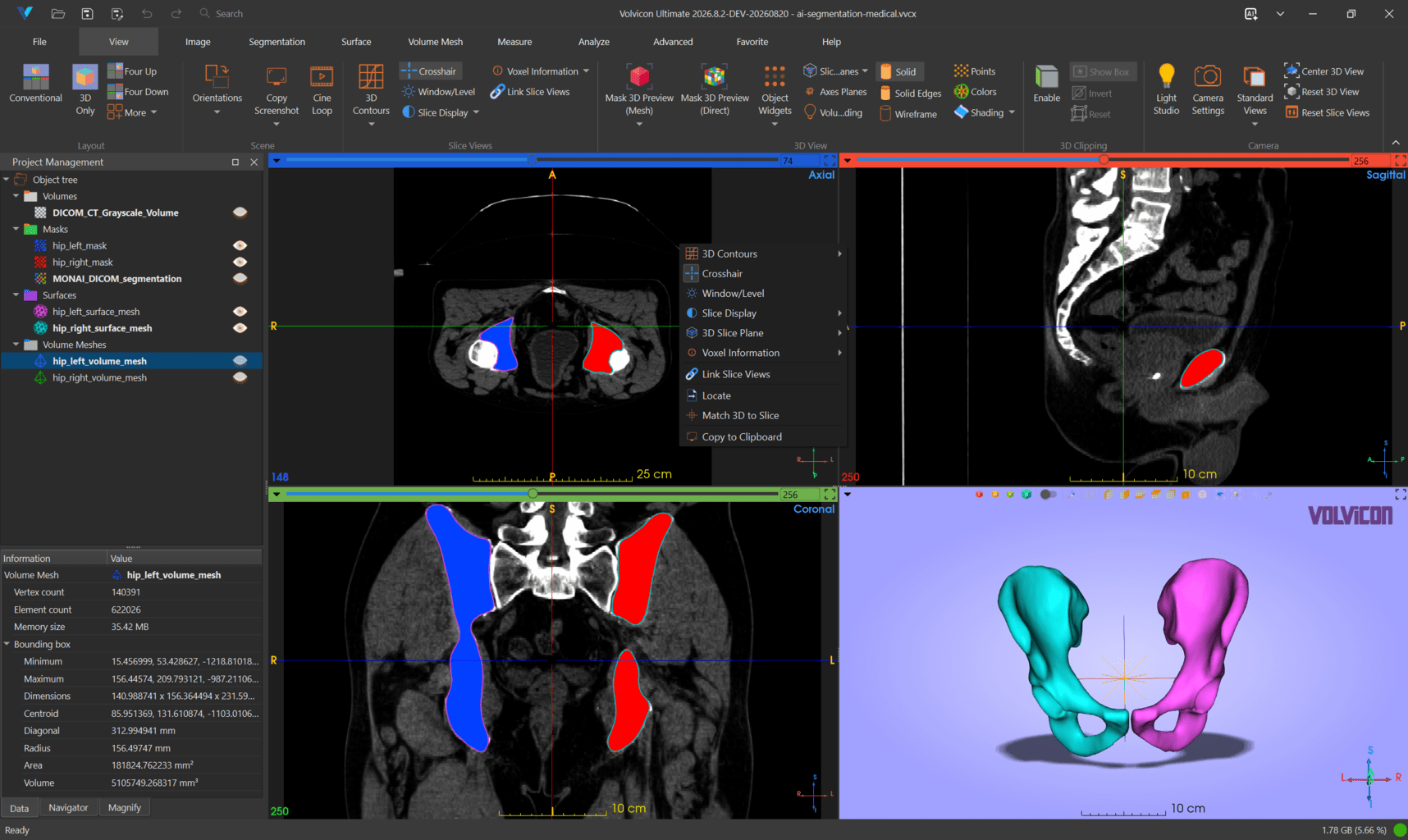 AI-assisted segmentation in Volvicon